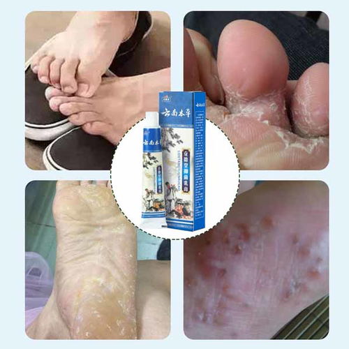 康凈衛(wèi)生用品 專業(yè)止癢噴劑廠家在線咨詢，您的個(gè)人衛(wèi)生守護(hù)者